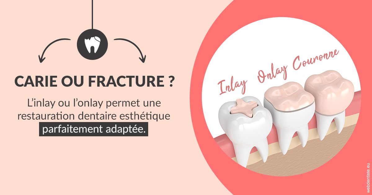 https://selarl-leclercq-patrice.chirurgiens-dentistes.fr/T2 2023 - Carie ou fracture 2