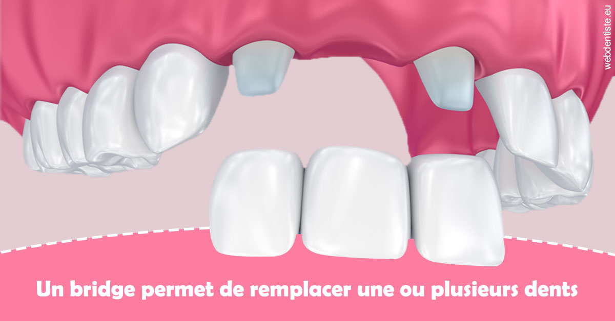 https://selarl-leclercq-patrice.chirurgiens-dentistes.fr/Bridge remplacer dents 2