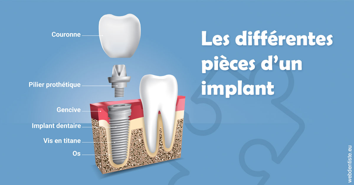 https://selarl-leclercq-patrice.chirurgiens-dentistes.fr/Les différentes pièces d’un implant 1